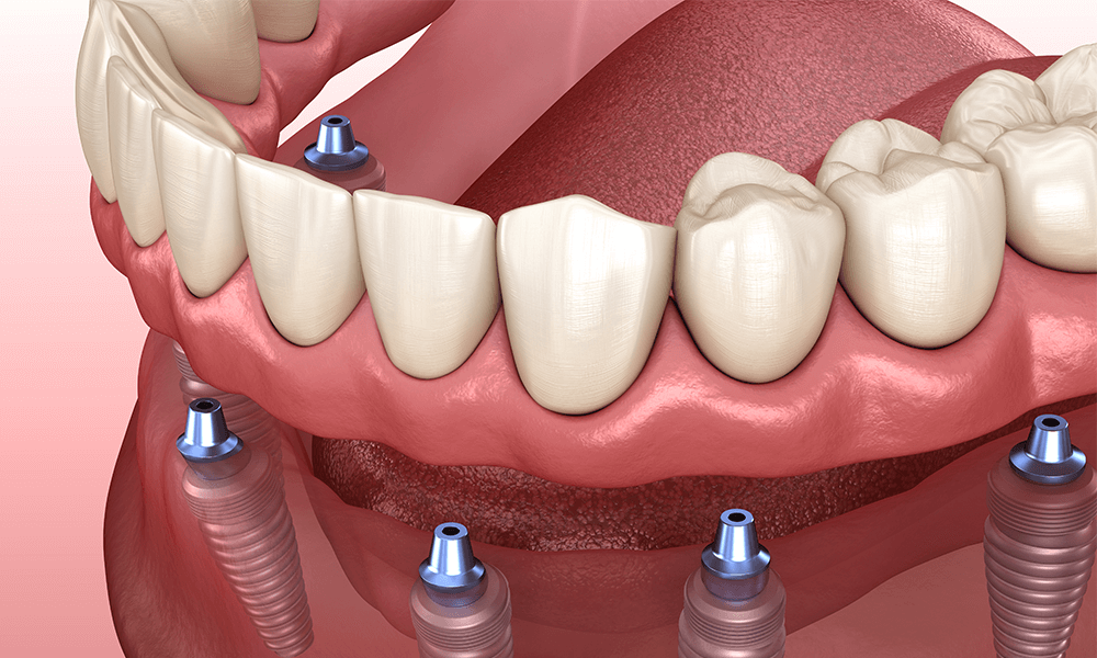 The Complete Guide to Dental Implants in Maroochydore